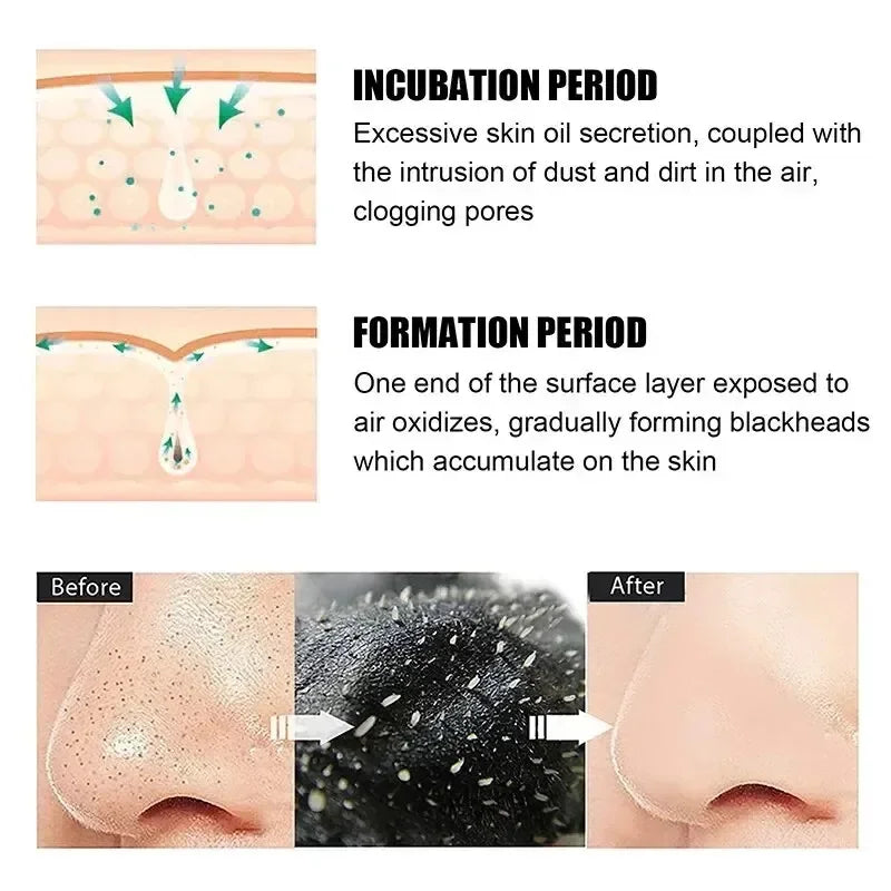 SUAKE Nasal Strips For Blackhead Removal And Pore Cleansing